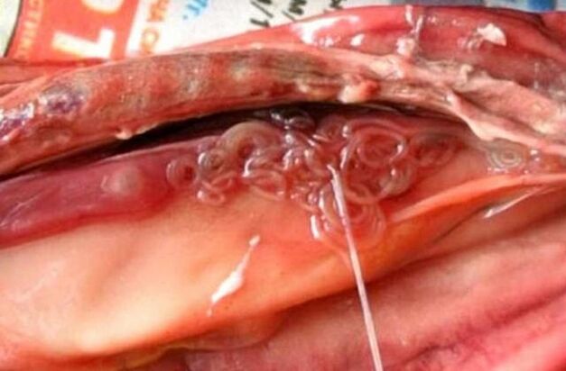 chance in the gallbladder